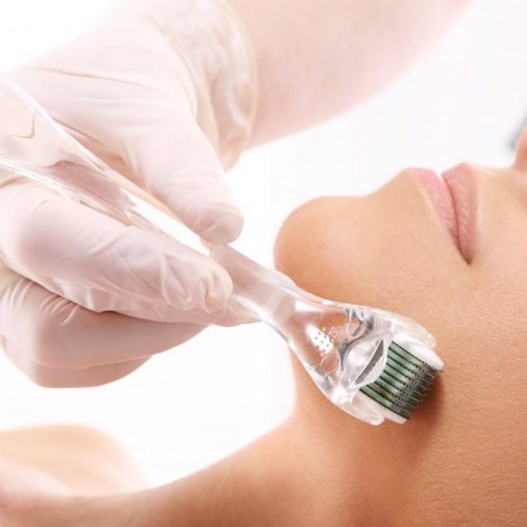 Microneedling Behandlungen in Germany